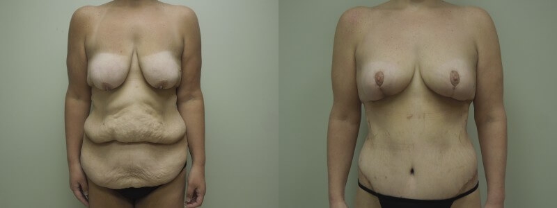 Post Massive Weight Loss Before & After Photos | Rottman Plastic Surgery