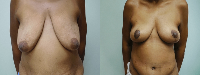 Post Massive Weight Loss Before & After Photos | Rottman Plastic Surgery