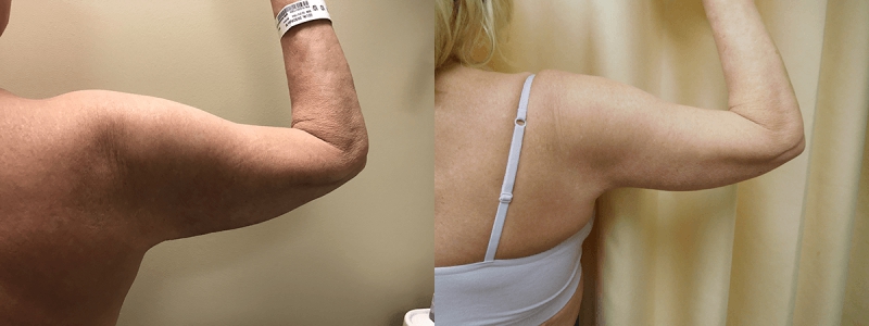 Post Massive Weight Loss Before & After Photos | Rottman Plastic Surgery