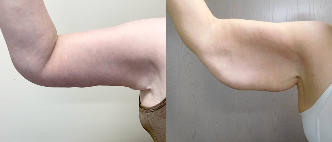 Post Massive Weight Loss Before & After Photos | Rottman Plastic Surgery