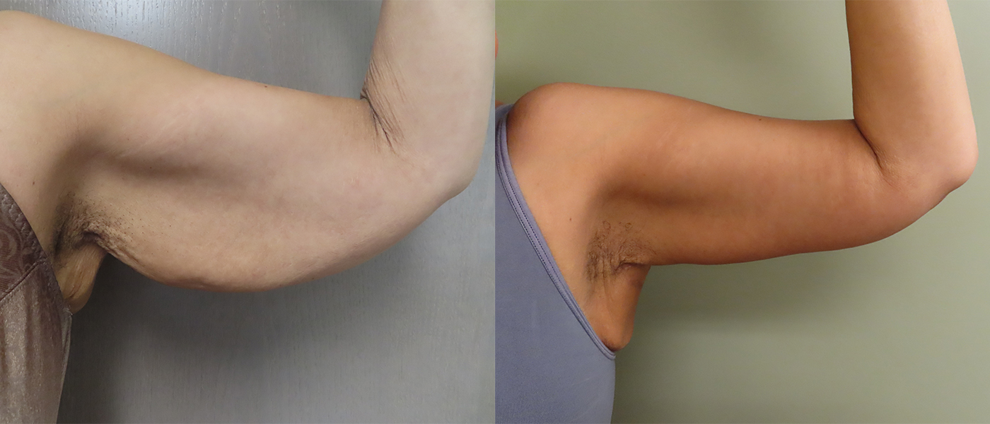 Post Massive Weight Loss Before & After Photos | Rottman Plastic Surgery