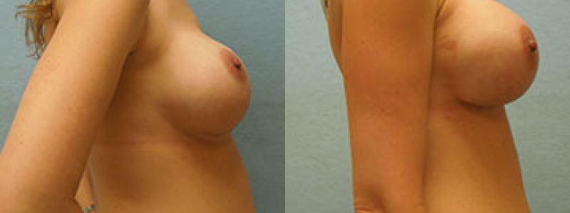 Revision Breast Surgery Before & After Photos | Rottman Plastic Surgery