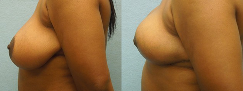 Revision Breast Surgery Before & After Photos | Rottman Plastic Surgery