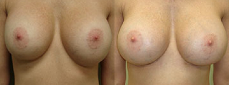 Revision Breast Surgery Before & After Photos | Rottman Plastic Surgery
