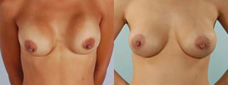 Revision Breast Surgery Before & After Photos | Rottman Plastic Surgery