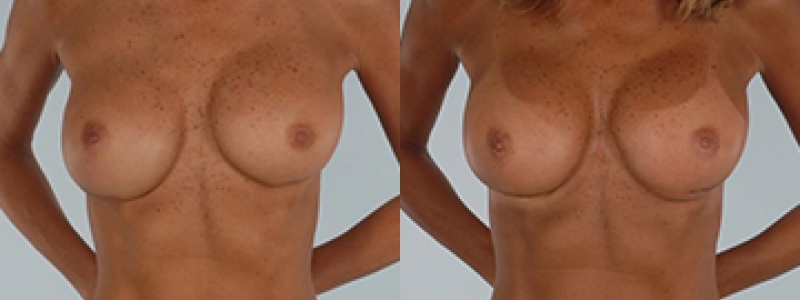 Revision Breast Surgery Before & After Photos | Rottman Plastic Surgery