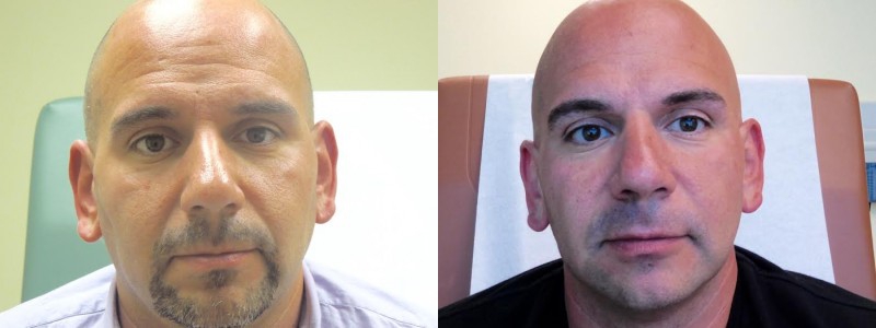 Sculptra Before & After Photos | Rottman Plastic Surgery