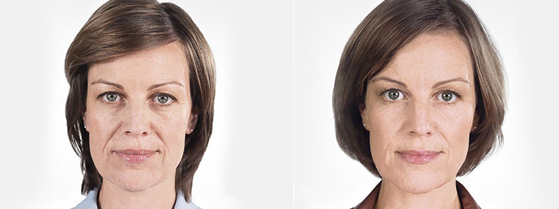 Sculptra Before & After Photos | Rottman Plastic Surgery