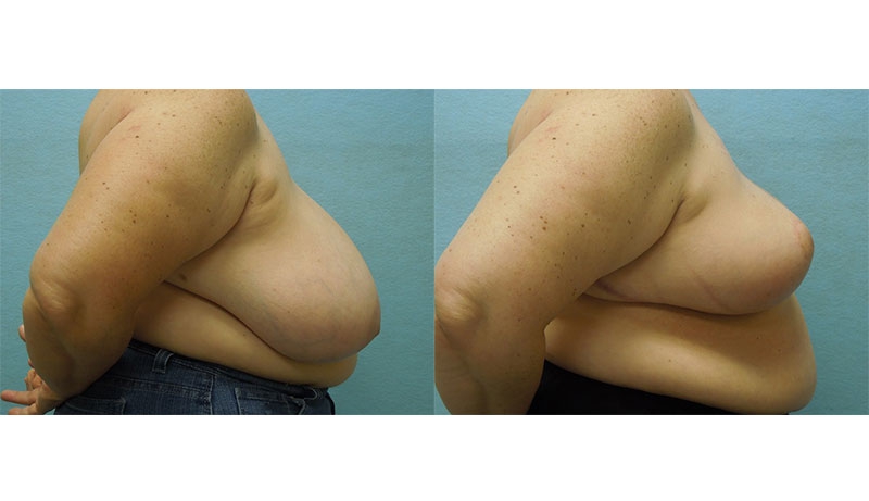Real patient results in Owings Mills, MD Performed by Steven J. Rottman MD