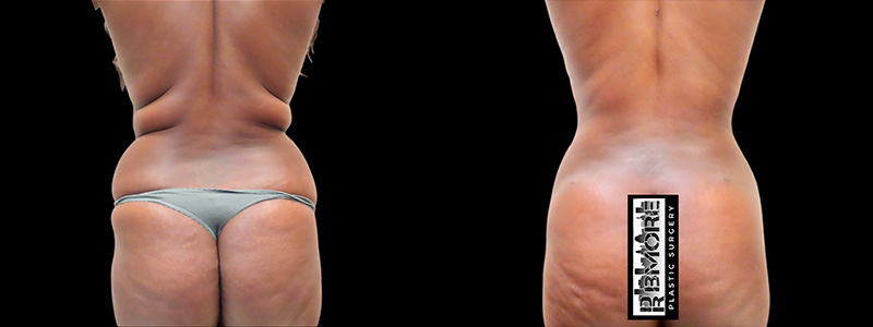 Real patient results in Owings Mills, MD Performed by Steven J. Rottman MD