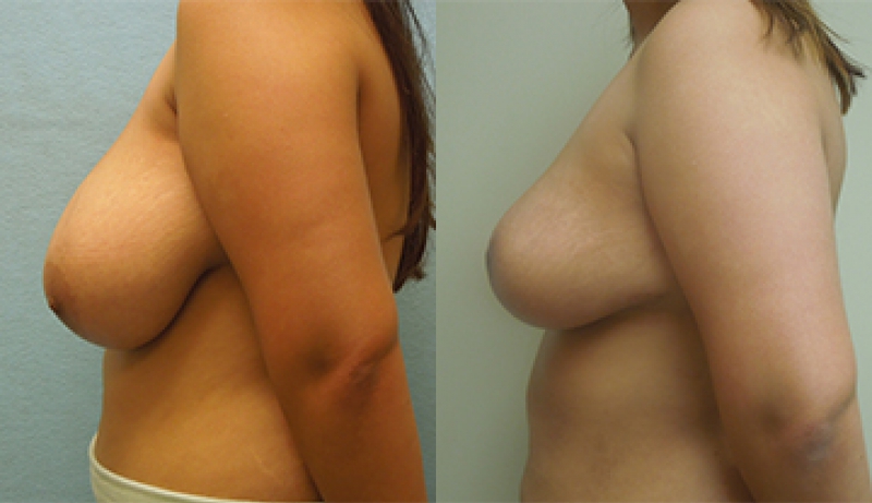 Real patient results in Owings Mills, MD Performed by Steven J. Rottman MD