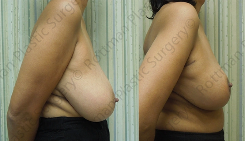 Real patient results in Owings Mills, MD Performed by Steven J. Rottman MD