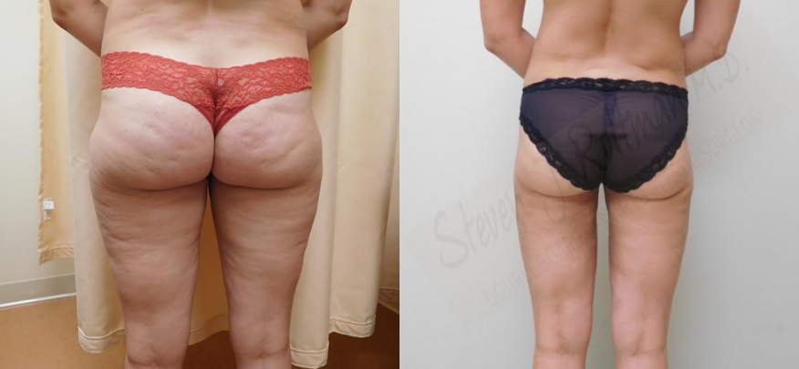 Real patient results in Owings Mills, MD Performed by Steven J. Rottman MD