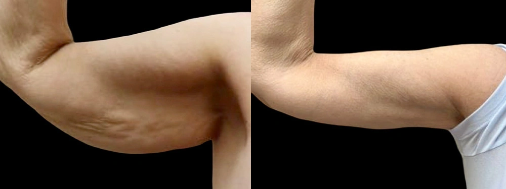 Real patient results in Owings Mills, MD Performed by Steven J. Rottman MD
