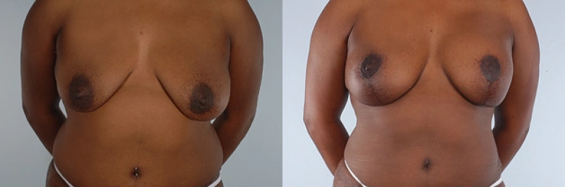 Real patient results in Owings Mills, MD Performed by Steven J. Rottman MD