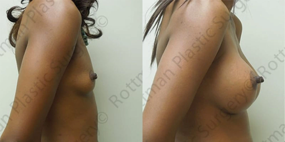 Real patient results in Owings Mills, MD Performed by Steven J. Rottman MD