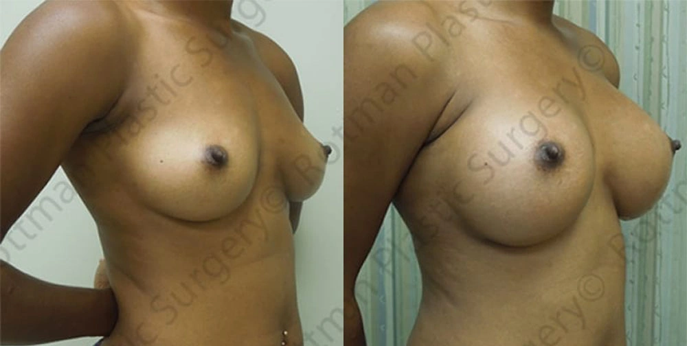 Real patient results in Owings Mills, MD Performed by Steven J. Rottman MD