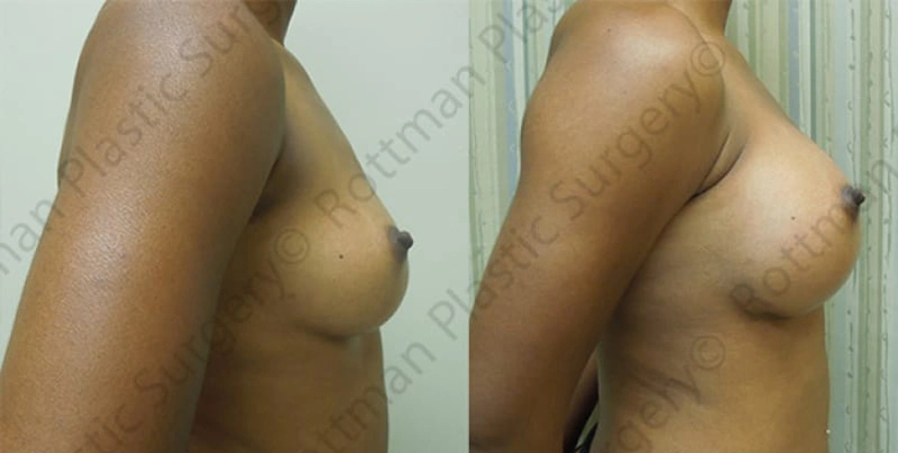 Real patient results in Owings Mills, MD Performed by Steven J. Rottman MD