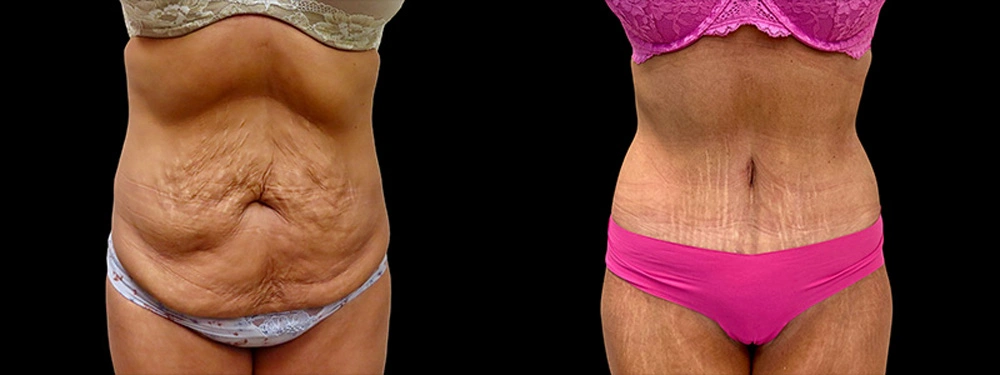 Real patient results in Owings Mills, MD Performed by Steven J. Rottman MD