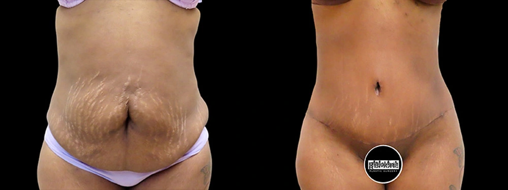 Real patient results in Owings Mills, MD Performed by Steven J. Rottman MD