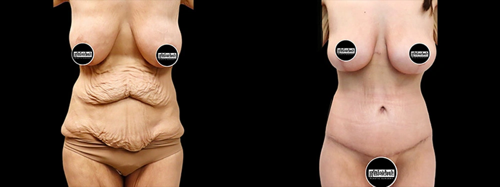 Real patient results in Owings Mills, MD Performed by Steven J. Rottman MD