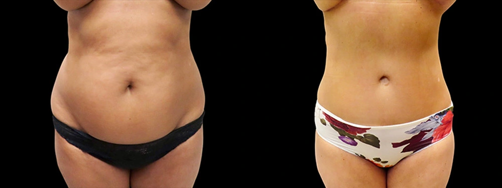 Real patient results in Owings Mills, MD Performed by Steven J. Rottman MD