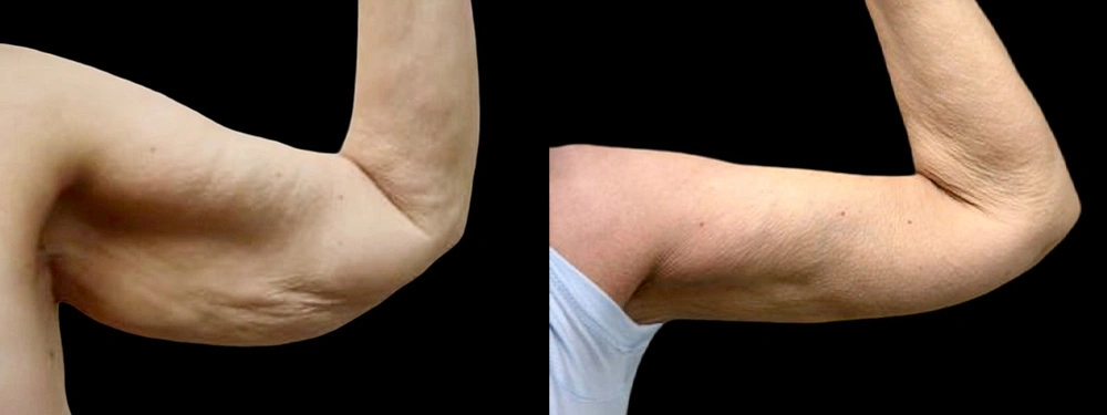 Real patient results in Owings Mills, MD Performed by Steven J. Rottman MD