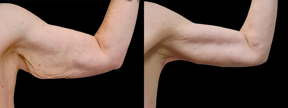 Real patient results in Owings Mills, MD Performed by Steven J. Rottman MD