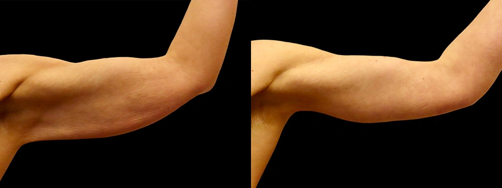 Real patient results in Owings Mills, MD Performed by Steven J. Rottman MD
