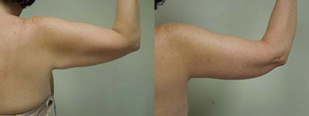 Real patient results in Owings Mills, MD Performed by Steven J. Rottman MD