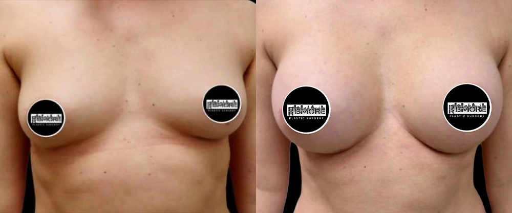 Real patient results in Owings Mills, MD Performed by Steven J. Rottman MD