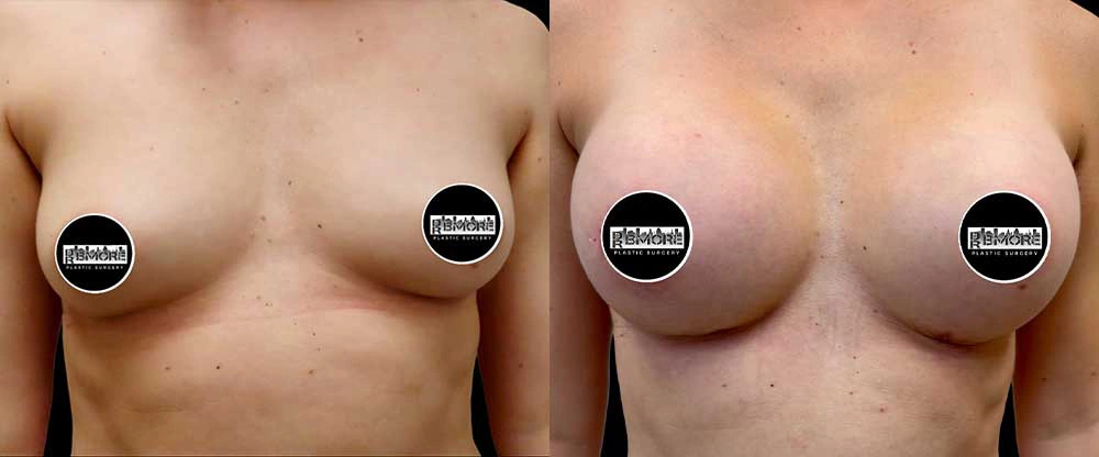 Real patient results in Owings Mills, MD Performed by Steven J. Rottman MD