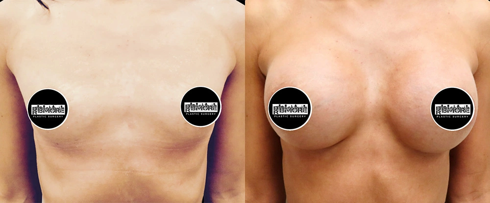 Real patient results in Owings Mills, MD Performed by Steven J. Rottman MD