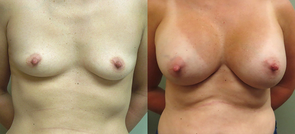 Real patient results in Owings Mills, MD Performed by Steven J. Rottman MD