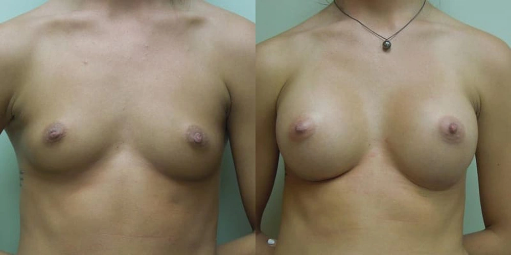 Real patient results in Owings Mills, MD Performed by Steven J. Rottman MD
