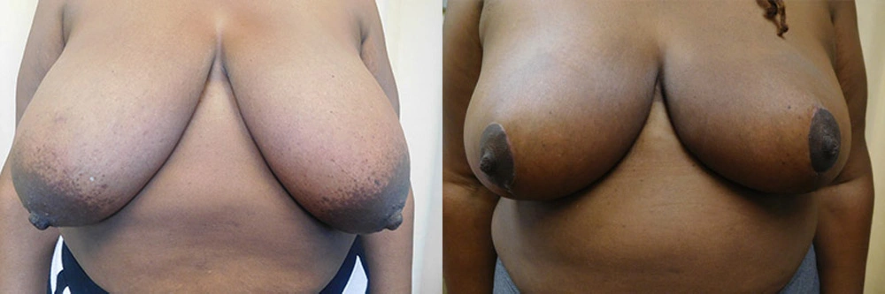 Real patient results in Owings Mills, MD Performed by Steven J. Rottman MD