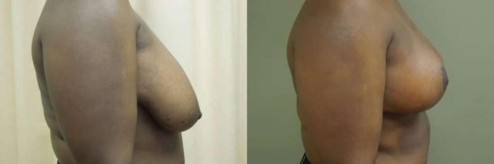 Real patient results in Owings Mills, MD Performed by Steven J. Rottman MD