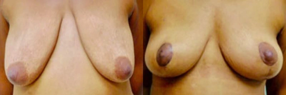 Real patient results in Owings Mills, MD Performed by Steven J. Rottman MD