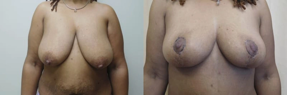 Real patient results in Owings Mills, MD Performed by Steven J. Rottman MD