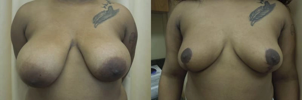 Real patient results in Owings Mills, MD Performed by Steven J. Rottman MD