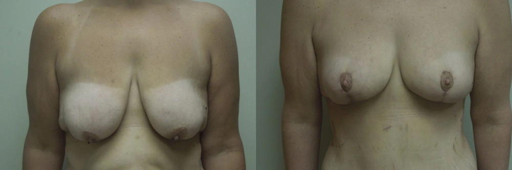 Real patient results in Owings Mills, MD Performed by Steven J. Rottman MD