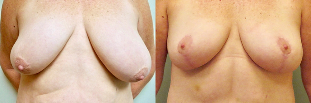 Real patient results in Owings Mills, MD Performed by Steven J. Rottman MD