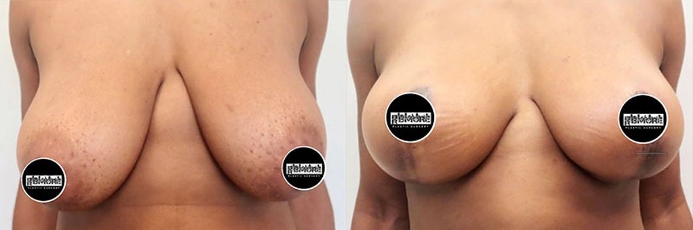 Real patient results in Owings Mills, MD Performed by Steven J. Rottman MD