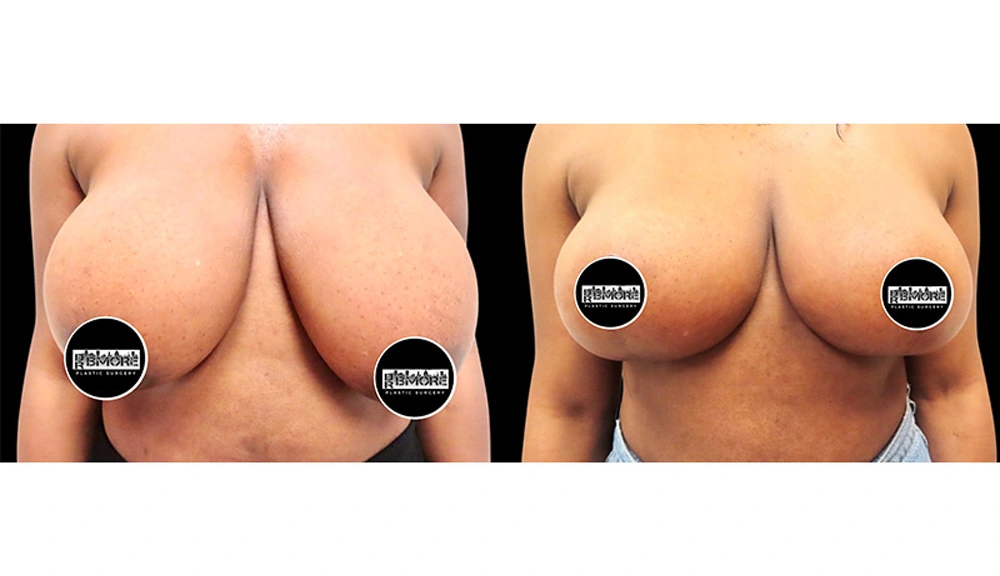 Real patient results in Owings Mills, MD Performed by Steven J. Rottman MD