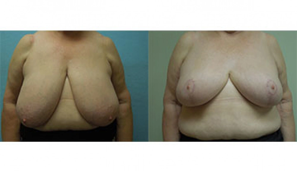 Real patient results in Owings Mills, MD Performed by Steven J. Rottman MD