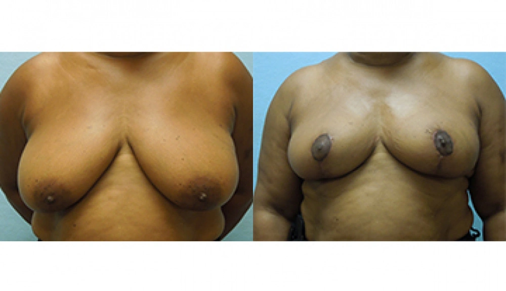 Real patient results in Owings Mills, MD Performed by Steven J. Rottman MD