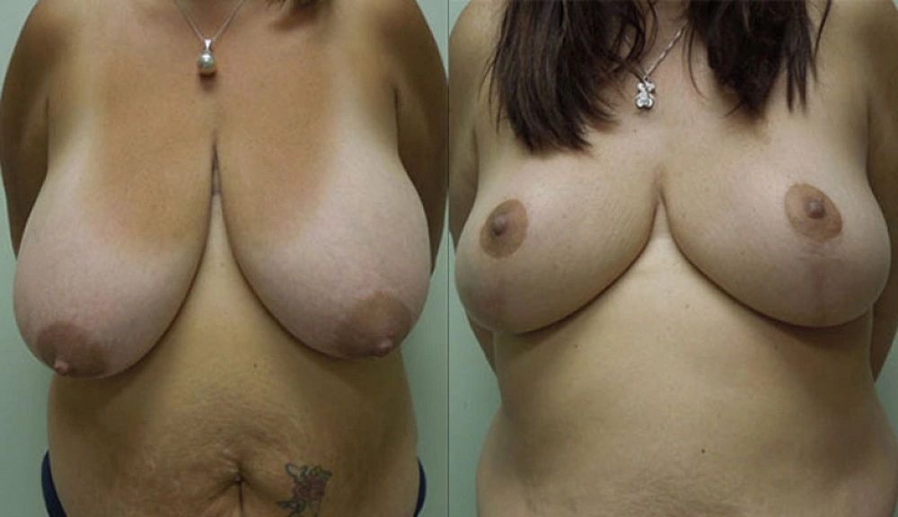 Real patient results in Owings Mills, MD Performed by Steven J. Rottman MD