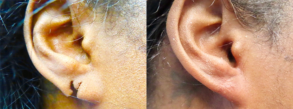 Real patient results in Owings Mills, MD Performed by Steven J. Rottman MD