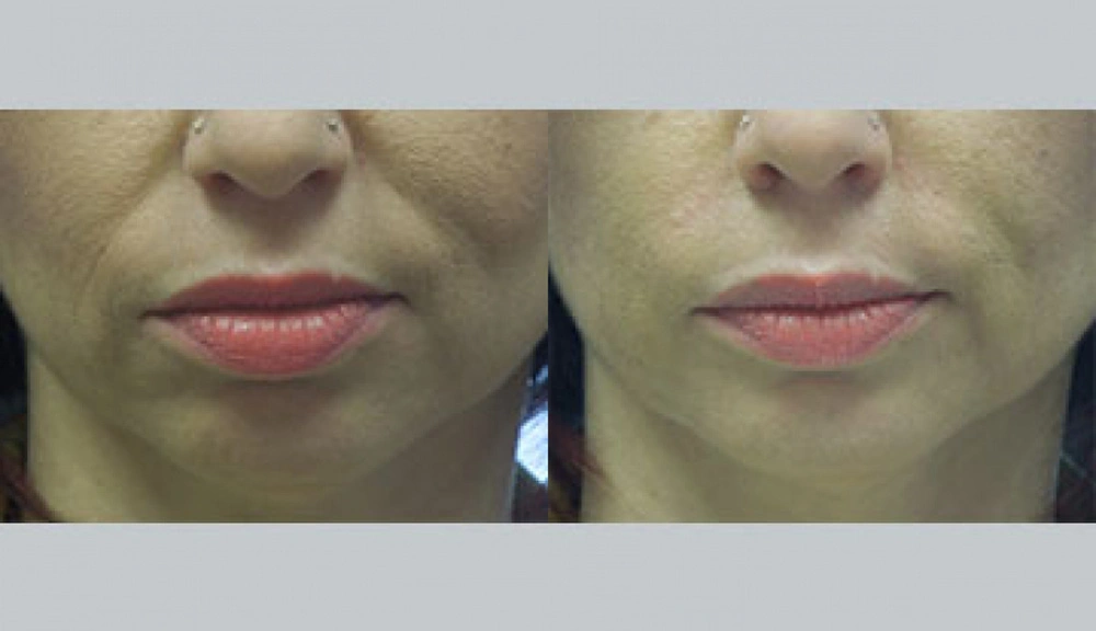 Real patient results in Owings Mills, MD Performed by Steven J. Rottman MD