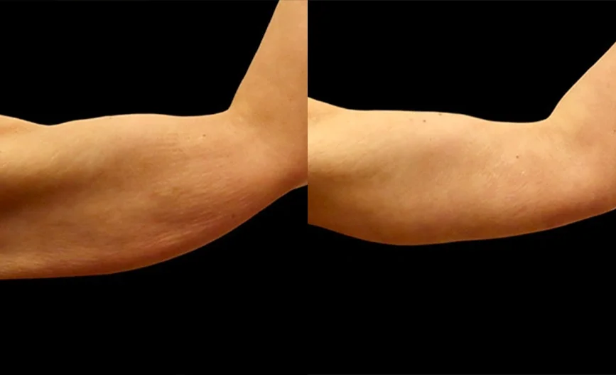 Real patient results in Owings Mills, MD Performed by Steven J. Rottman MD